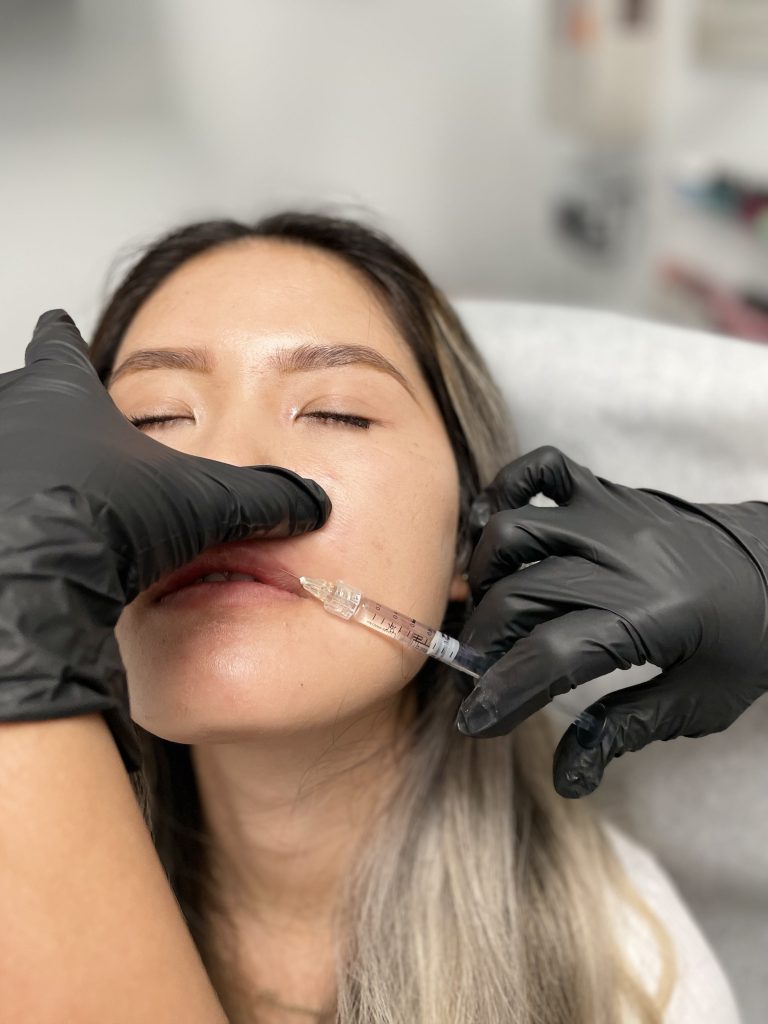 versa-dermal-filler-san-antonio